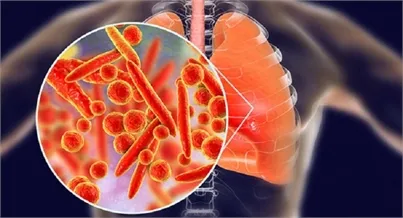 Cảnh báo bệnh viêm phổi cấp do Legionella